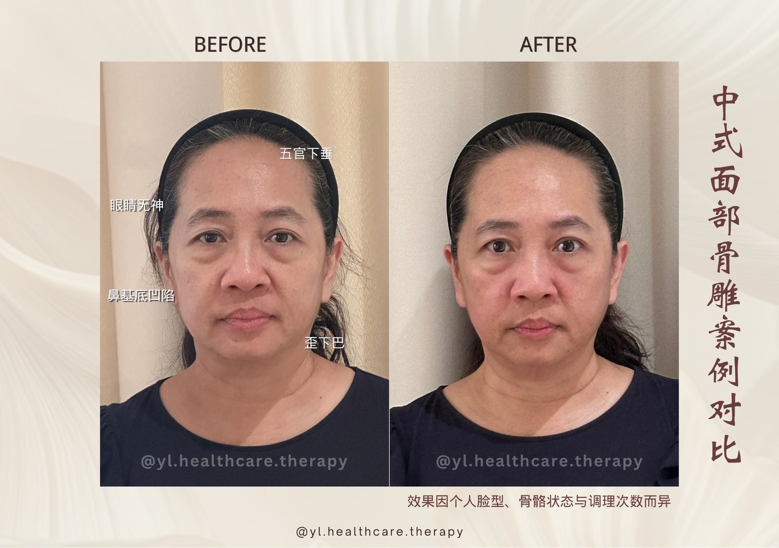 Oriental Facial Resculpture reference