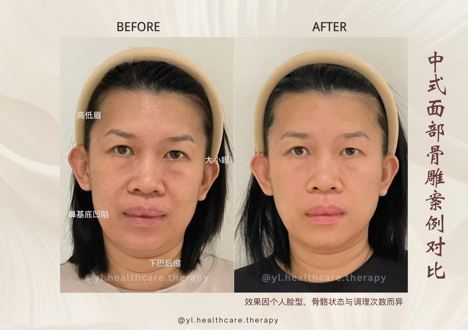 Oriental Facial Resculpture reference