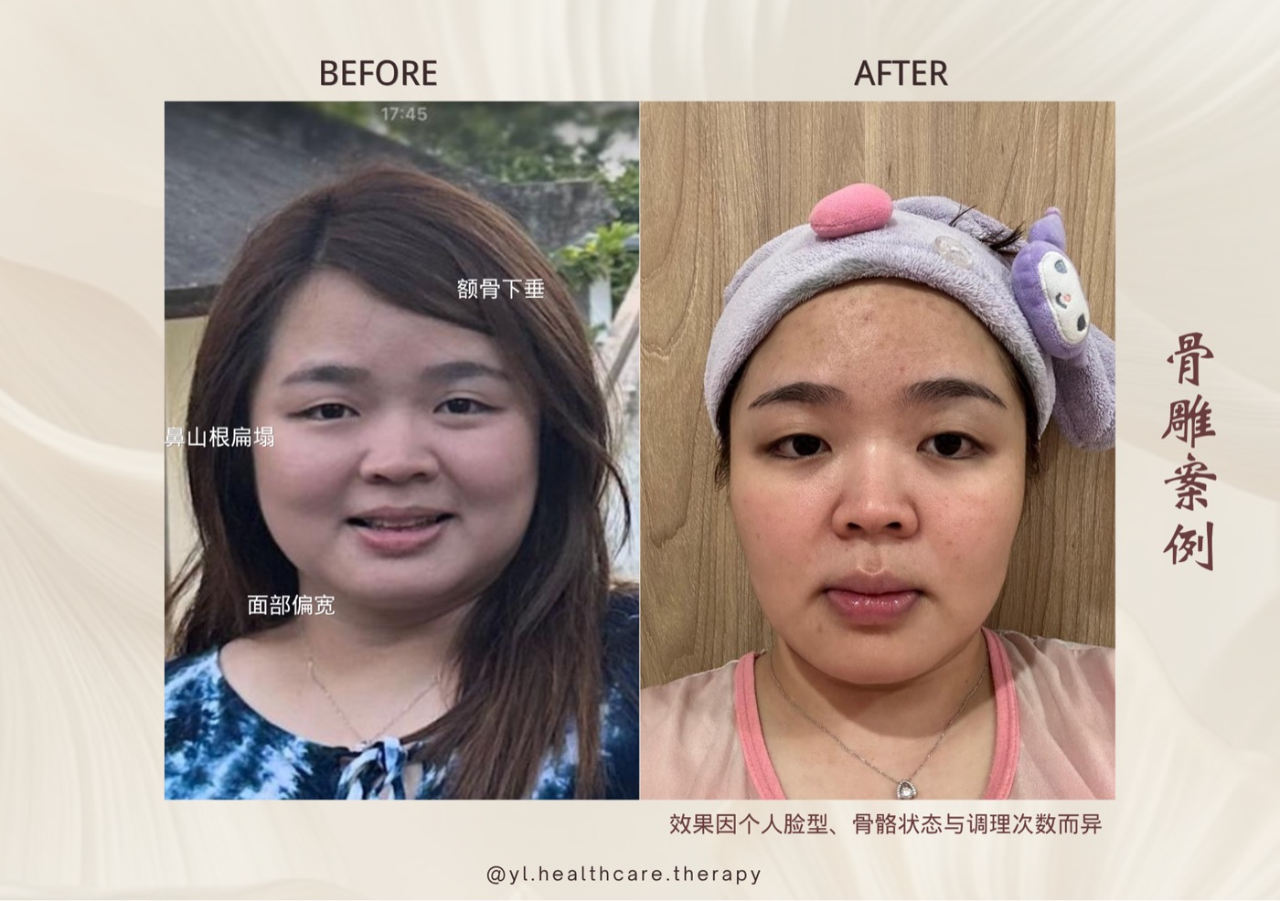 Oriental Facial Resculpture reference